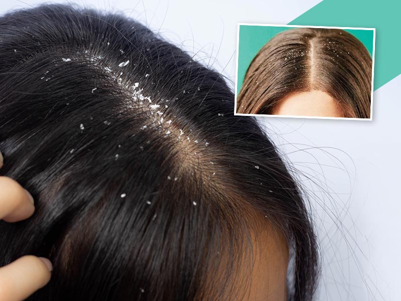 drydandruff